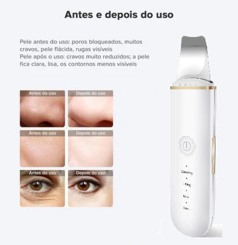 Peeling Ultrassônico - Removedor de cravos e limpador facial para Skincare